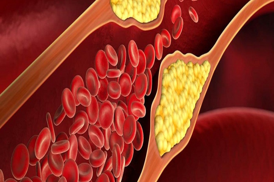 Covid infection spiked high cholesterol risk by 30pc