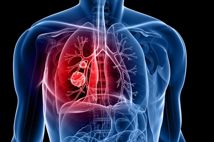 Doctors raise concern over rising lung cancers among non-smokers in India