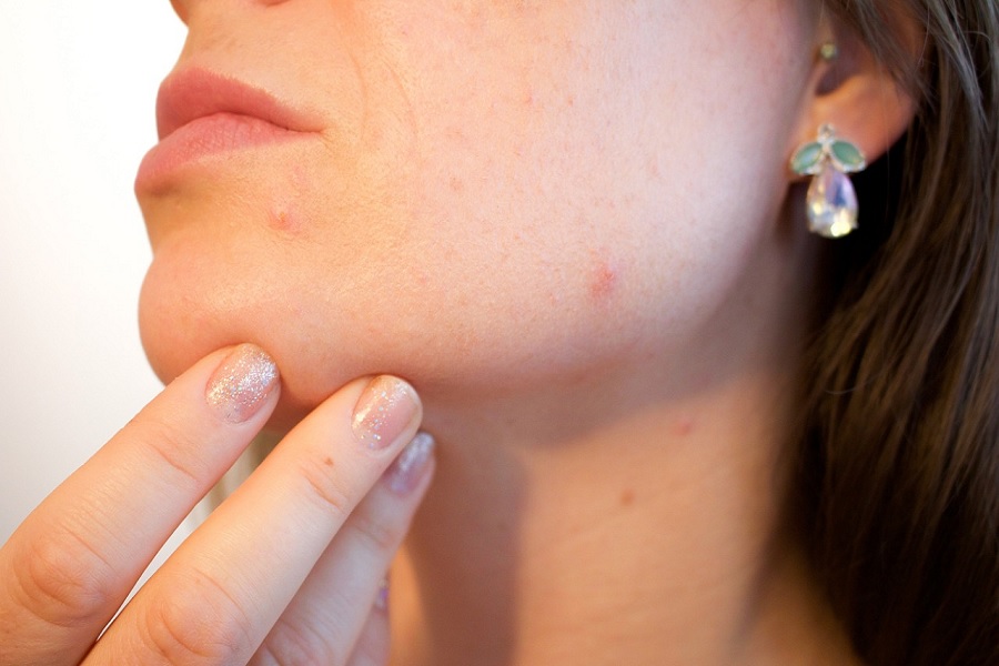 How to Tackle Acne and Breakouts: Treatment and Prevention Tips