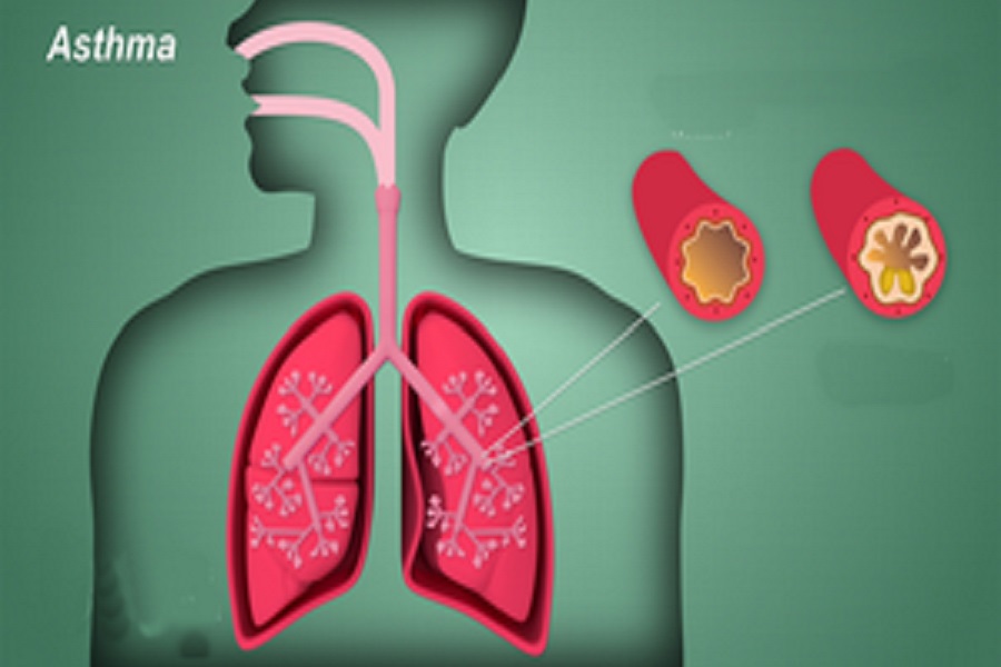 Targeted therapies, diagnostics remain concern for severe asthma