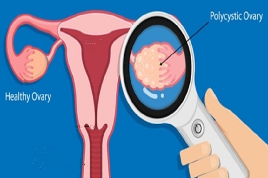 US researchers decode origins of ovarian cancer