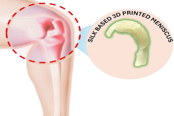 IIT Guwahati develops 3 ingenious therapies for knee meniscus tear