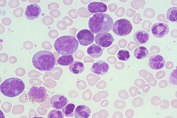 How targeted therapies are boosting outcomes for bone marrow cancer