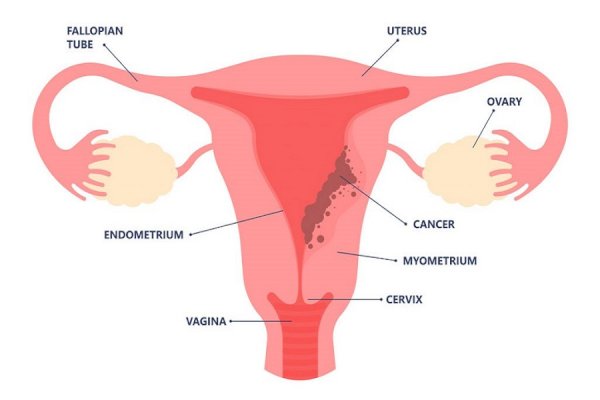 Why gynaecological cancers are rising among young Indian women