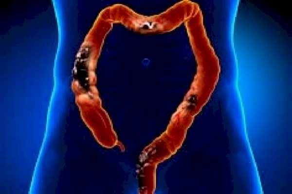 Study shows how stress worsens colorectal cancer