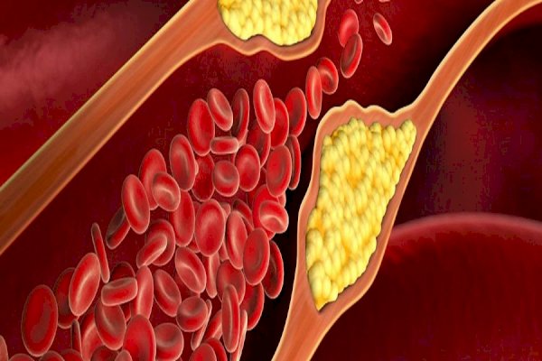 Covid infection spiked high cholesterol risk by 30pc