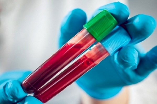 Blood-biomarker tests may aid in early diagnosis of Alzheimer’s