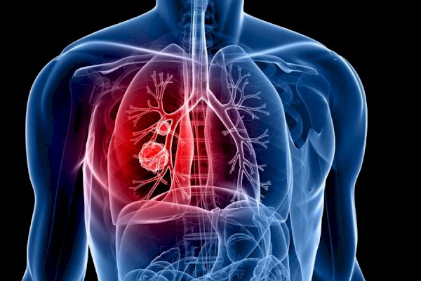 Doctors raise concern over rising lung cancers among non-smokers in India