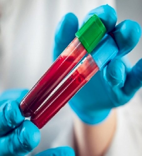 Blood-biomarker tests may aid in early diagnosis of Alzheimer’s