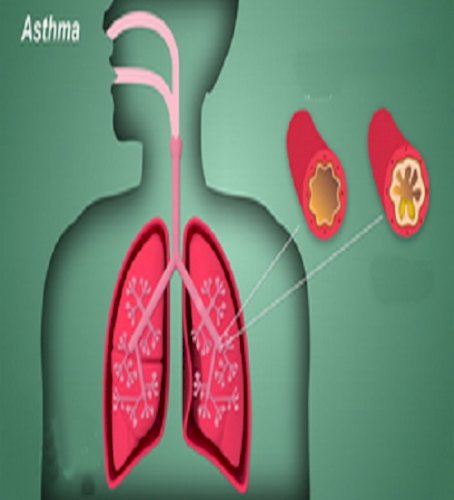 Targeted therapies, diagnostics remain concern for severe asthma