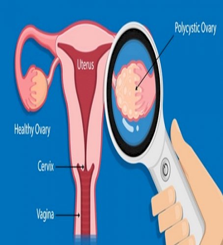 Women with PCOS likely to have attention, cognitive issuesv