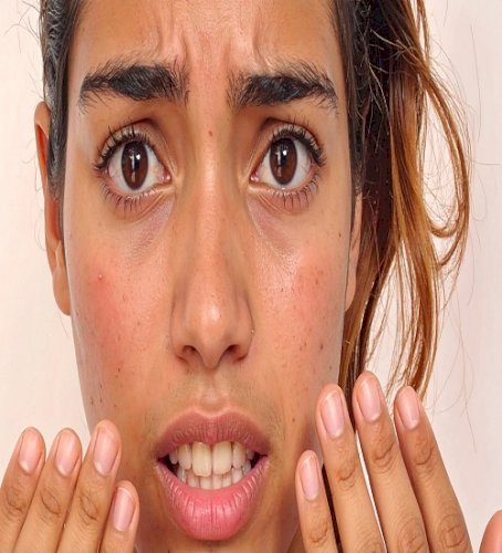 The risk of sunburn increases in strong sunlight; get relief from aloe vera, cucumber and rose water.